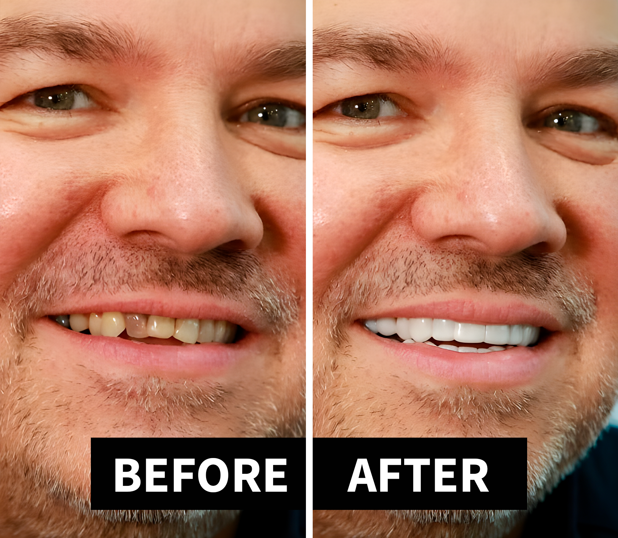 Shiny Smile Veneers Reviews